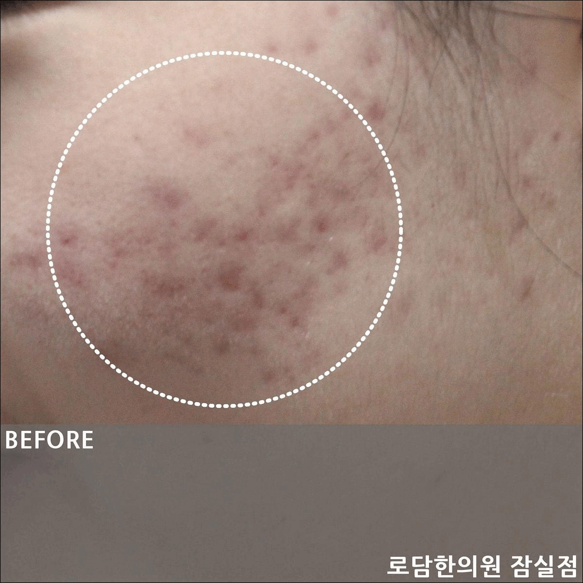  잠실 여드름 흉터 제거 치료 과정 새살침