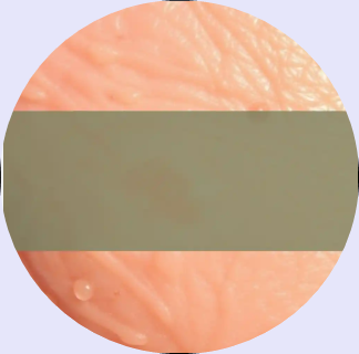 광선각화증 치료비용, 피부암 초기증상, 광선각화증 레이저치료, 	피부과 자외선 치료, 피부 각질 병변, 자외선 차단제 추천, 광선각화증 자연치료, 광선각화증 증상 사진, 피부암 예방 자연약초, 얼굴 각질 붉은 반점 원인