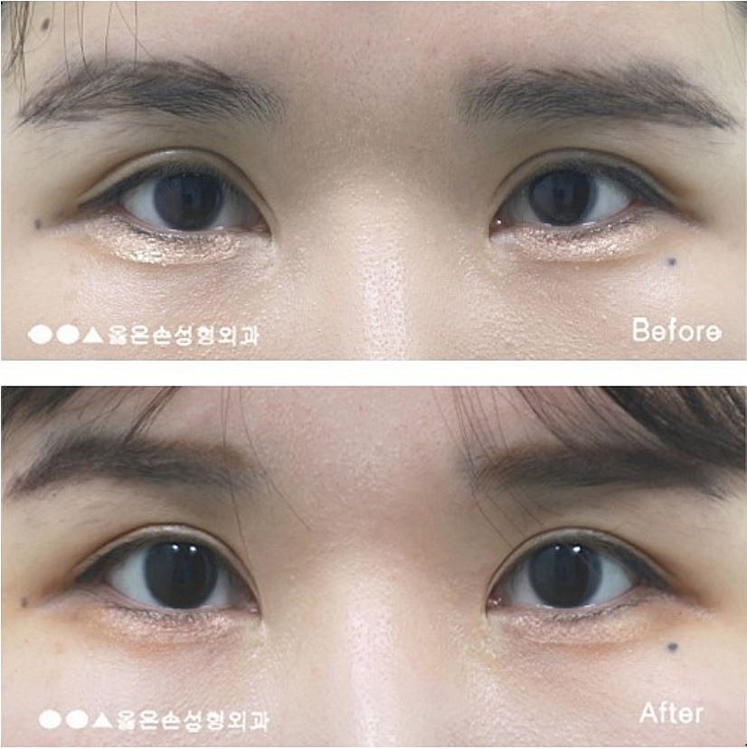 눈재수술잘하는병원 매우 만족해요 눈재수술잘하는병원 매우 만족해요