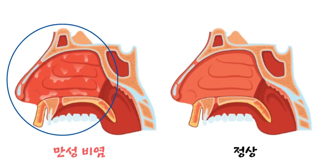 만성-비염-원인
