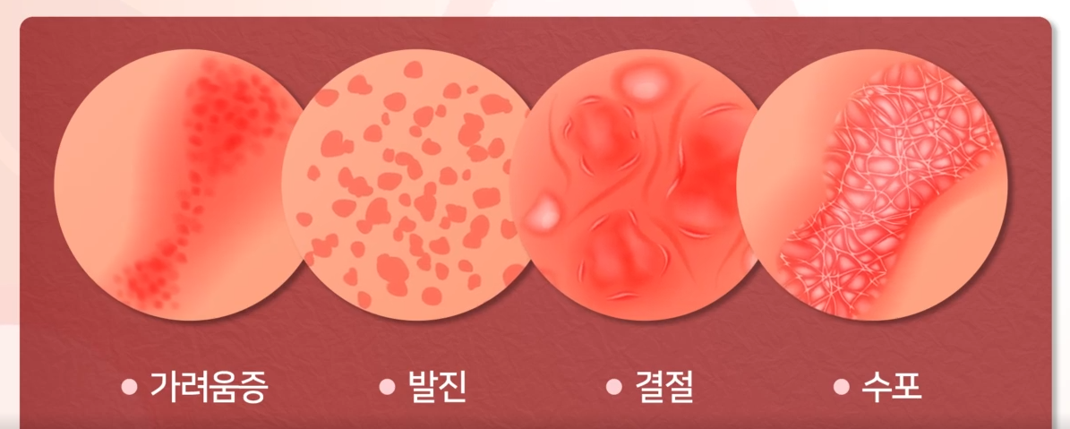 옴증상 원인 검사 치료 경과 합병증 예방방법