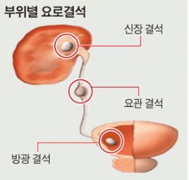 요로결석 증상