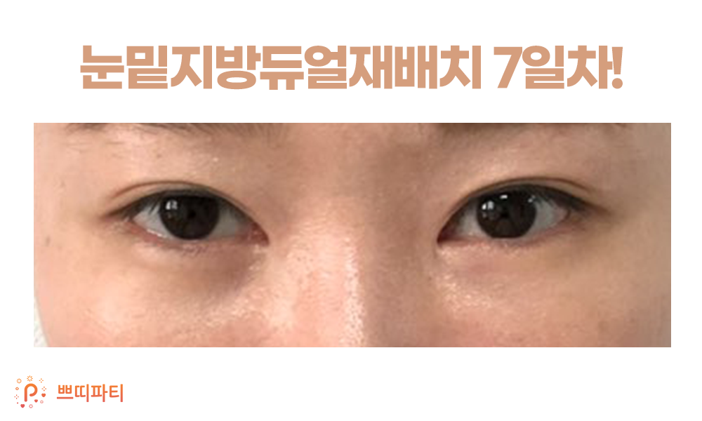  눈밑지방재배치 레이저로 흉터 고민 줄여! (+눈밑지후기)