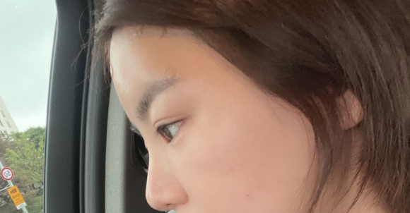 이마필러잘하는곳 후기! 8