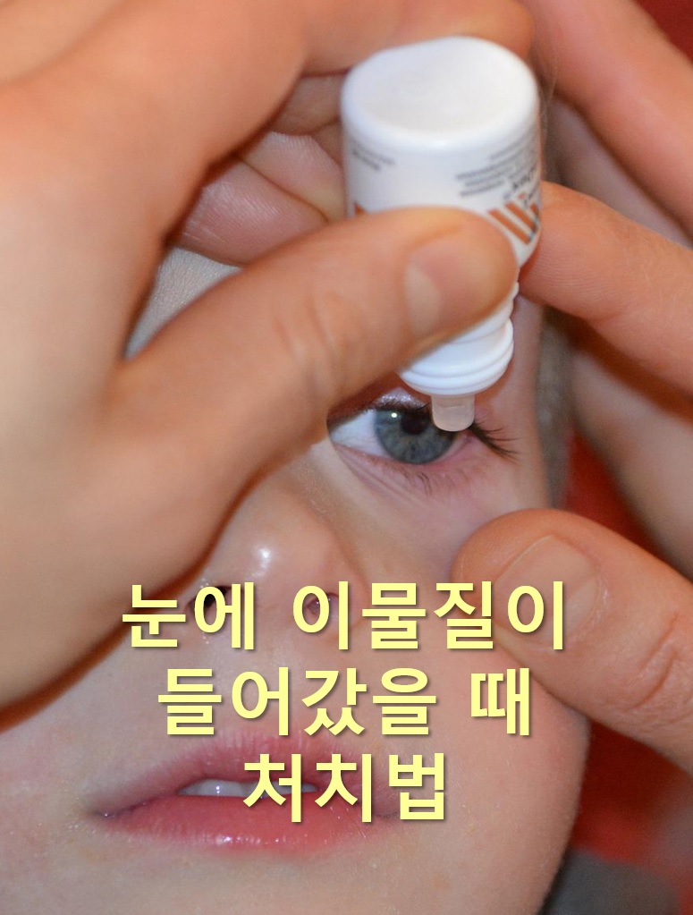  눈에 이물질이 낀 것 같은 증상과 눈에 이물질이 들어갔을 때 처치법