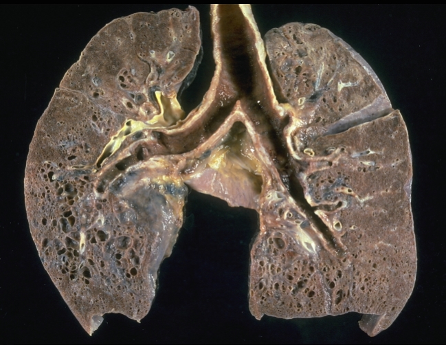 폐섬유증이란 무엇인가요?