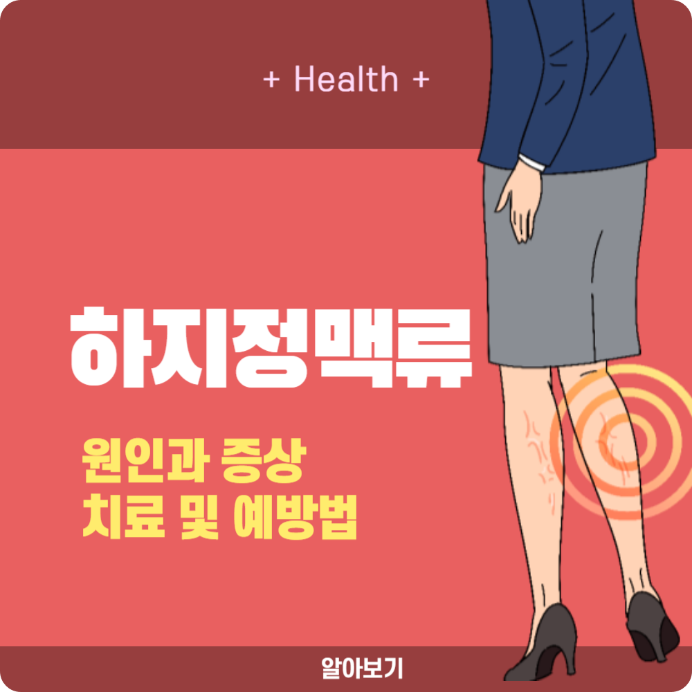 하지정맥류 원인 증상 및 치료 방법, 예방법 알아보기