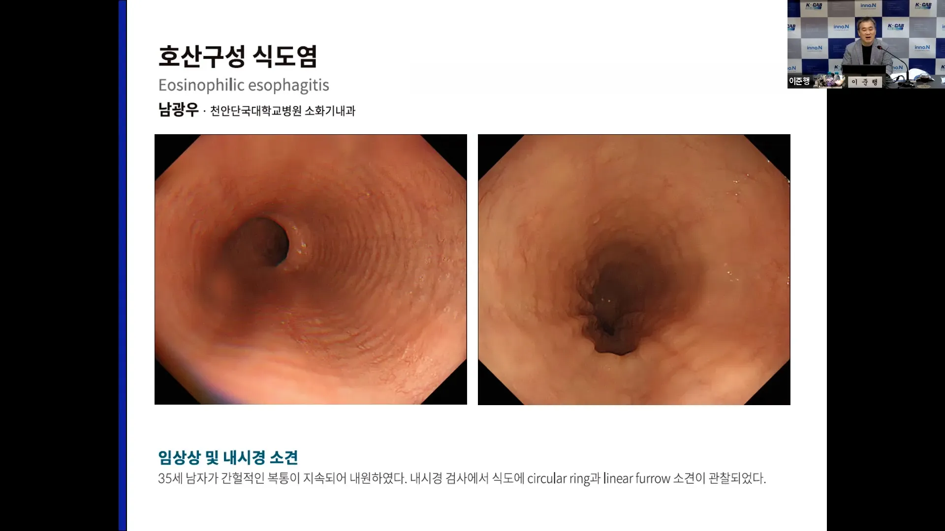 식도염에 좋은 음식 안좋은 음식_1