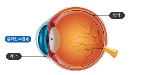 백내장 증상
