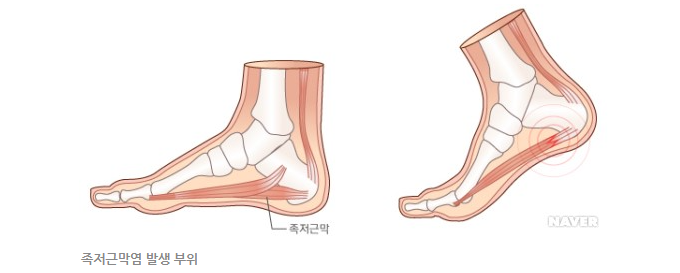 족저근막염 개요