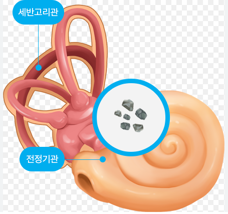 이석증 원인
