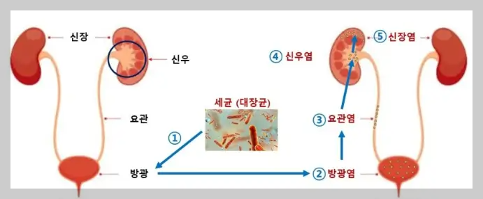 신우신염과 방광염