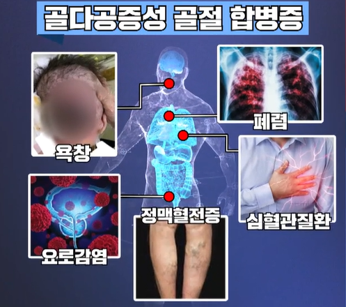 골다공증의 위험성