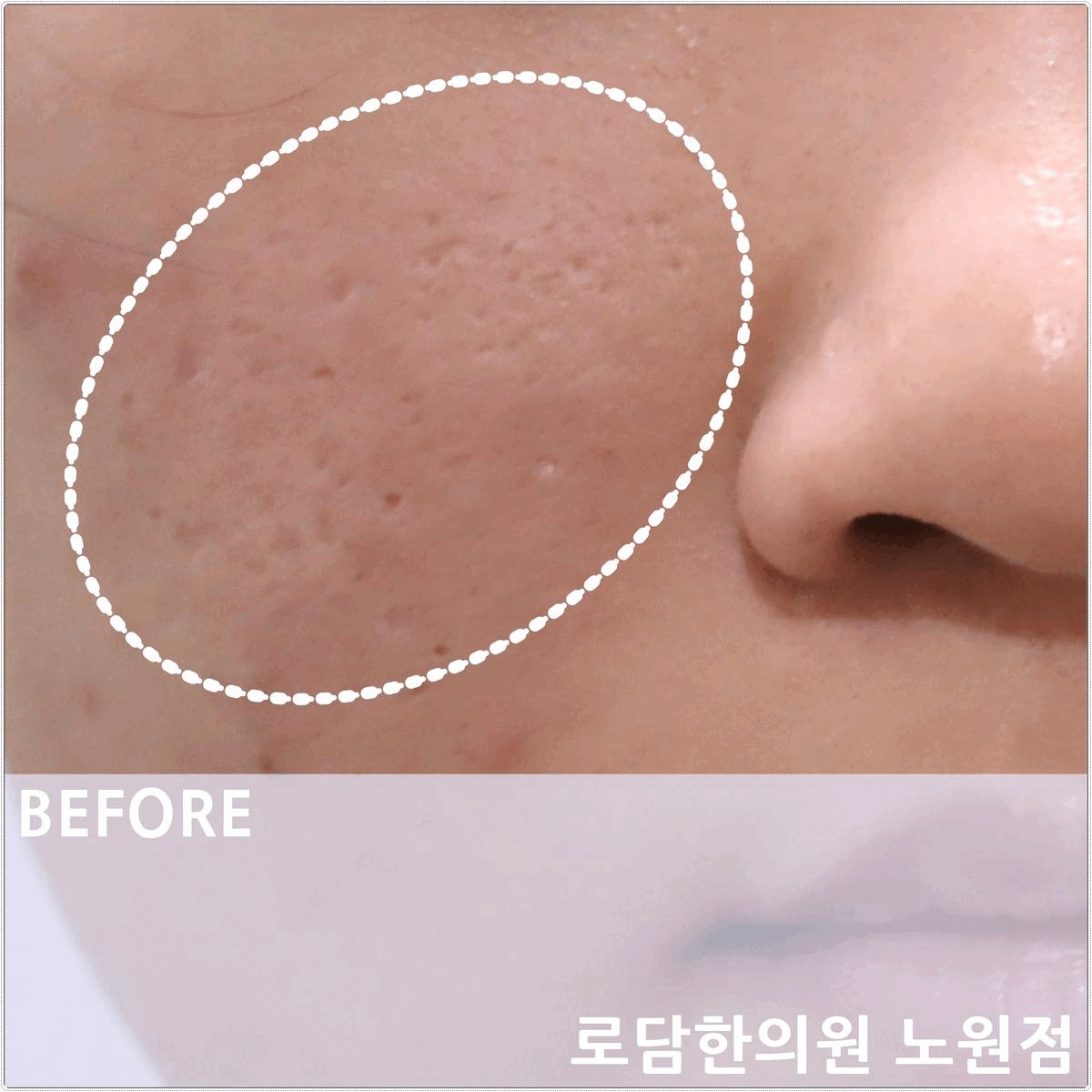  별내 여드름 흉터 피부과가 아닌 한의원 새살침 치료