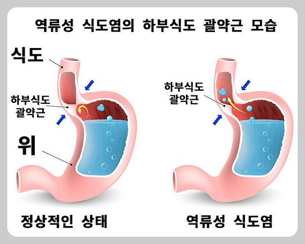 The appearance of the lower esophageal sphincter in reflux esophagitis