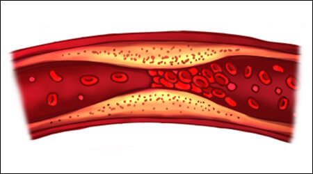 콜레스테롤이 쌓인 혈관벽