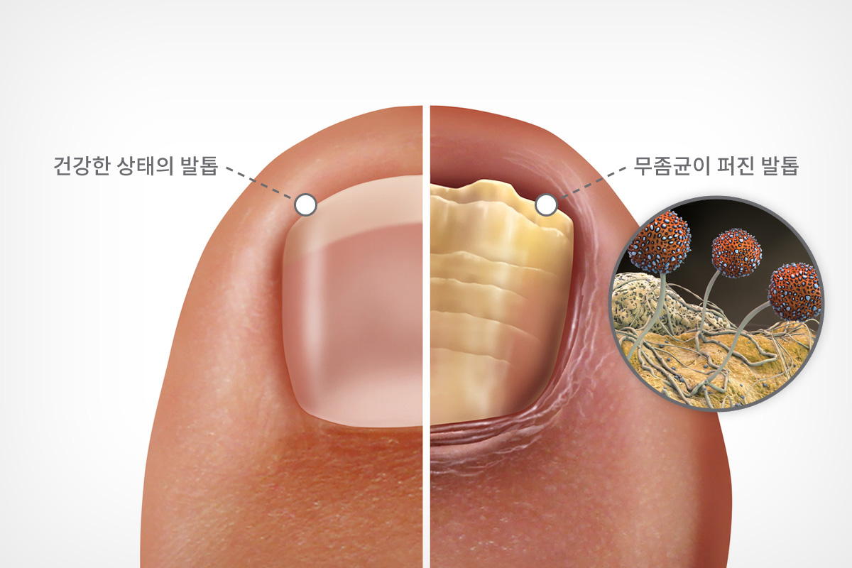  발톱무좀이란 곰팡이균인 피부사상균이 손톱이나 발톱에 침투하여 생기는 질환