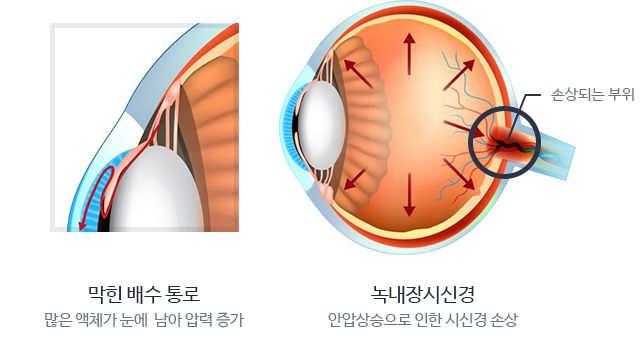 녹내장 증상