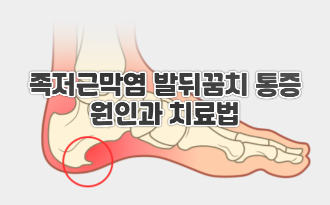  족저근막염 발뒤꿈치 통증의 원인과 치료법