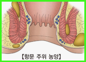 아기 항문 덧살 농양 항생제 수술 관리