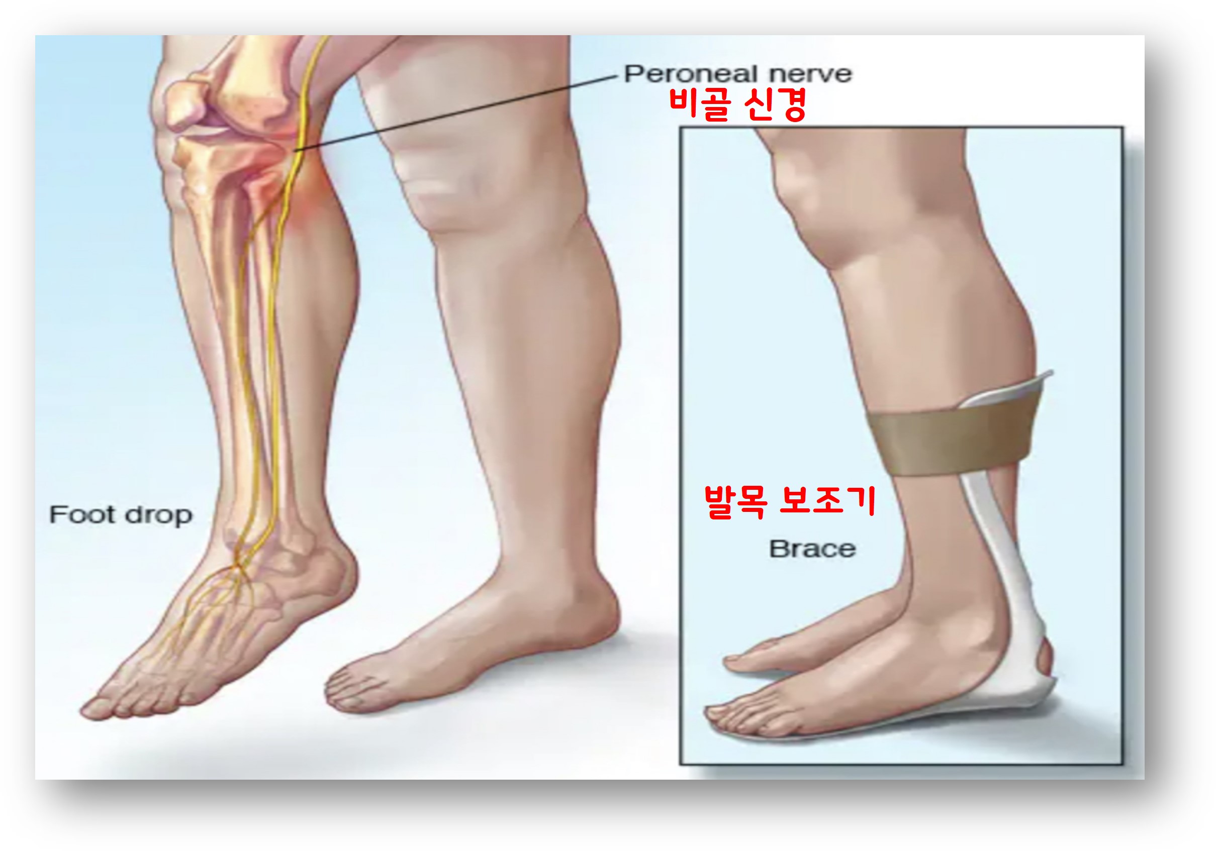 발목 보조기