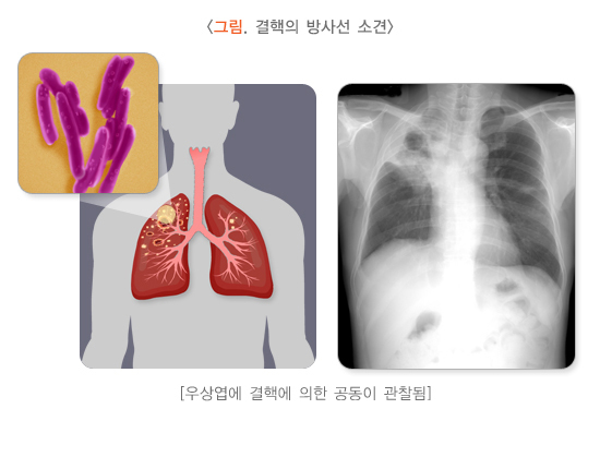  직업성 감염성폐질환