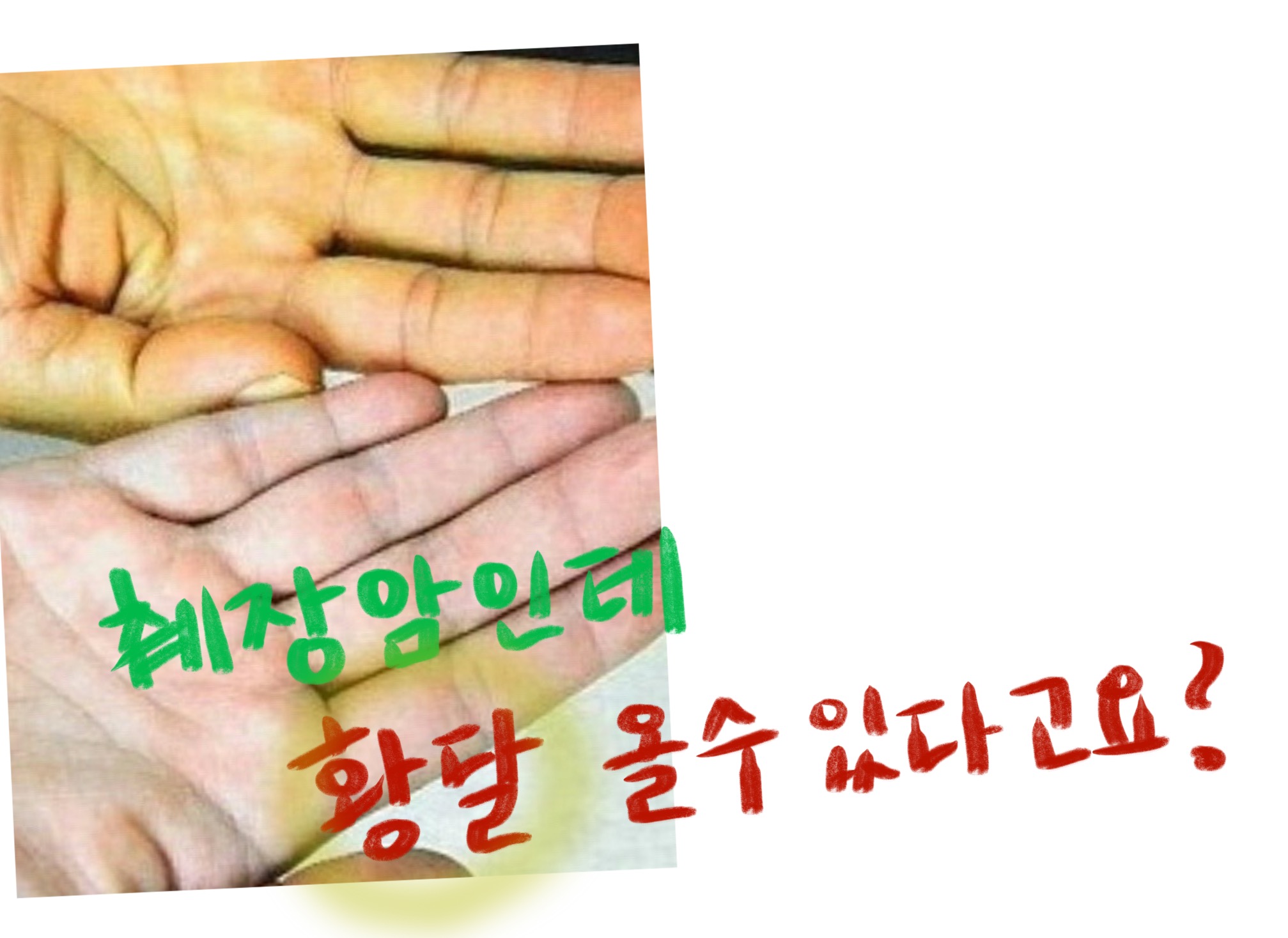  췌장암 초기증상 , 알고 있으면 도움되는 정보