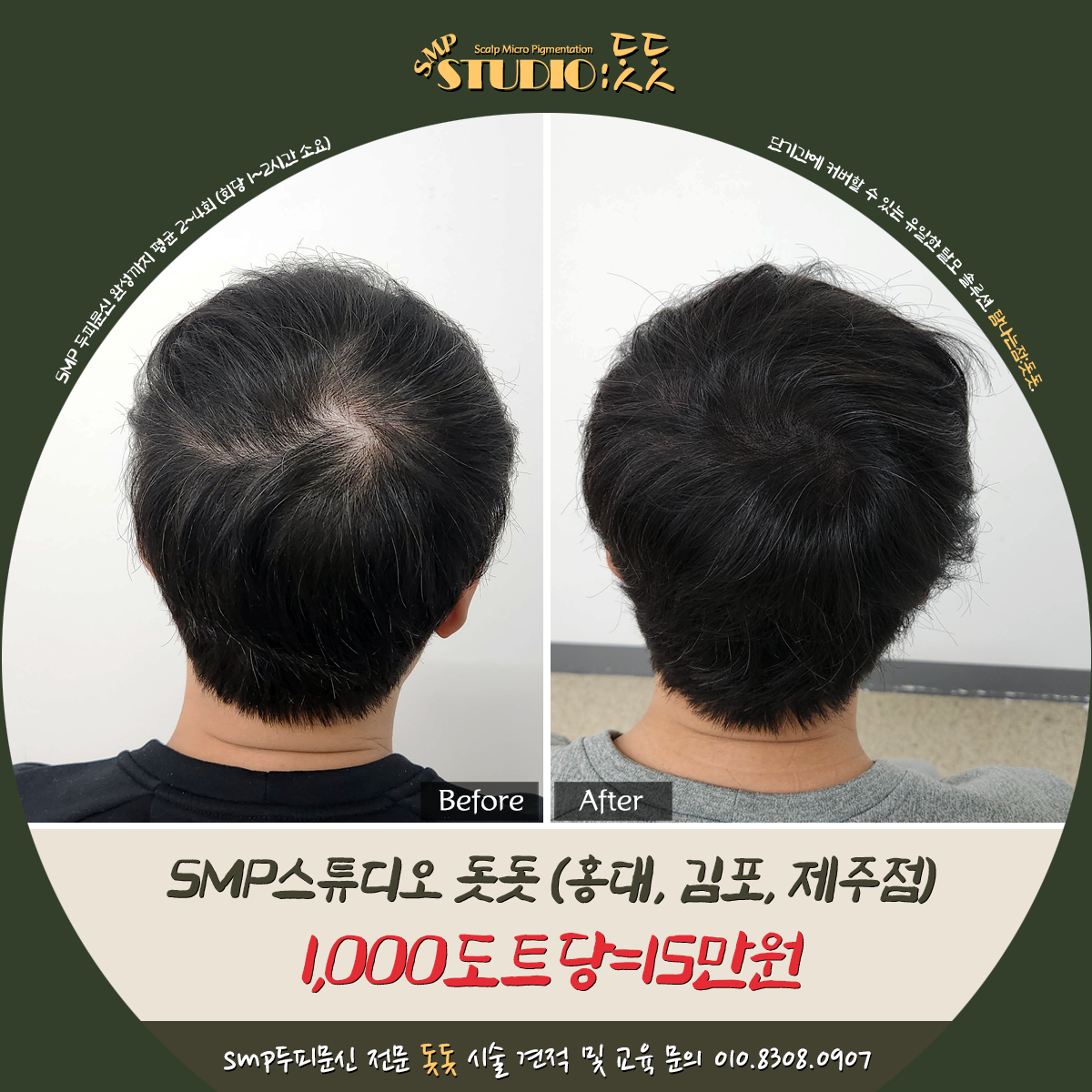  인천 두피문신 잘하는곳 가격 확인과 전후 비교