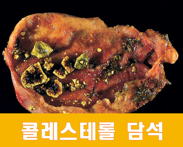일으키는 담석증의 원인, 증상은? 오른쪽 윗배의 통증을