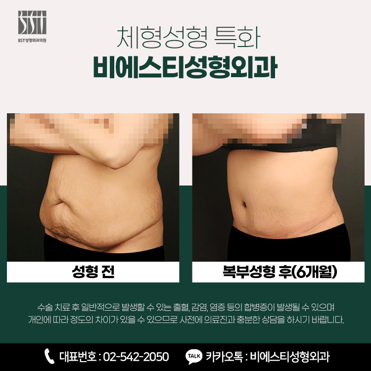 복부성형 6개월 후 측면 전후 비교 사진