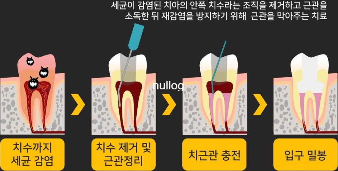 의정부 어금니 신경치료 비용을 조기에 상담하세요 4