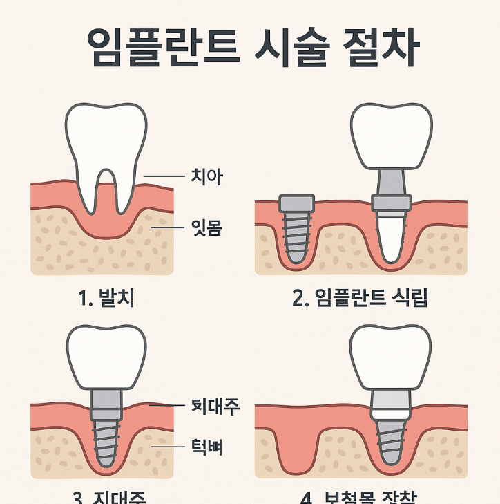 임플란트 시술 절차를 설명하는 인포그래픽. 발치, 임플란트 식립, 지대주 연결, 보철물 장착 순서로 구성됨.