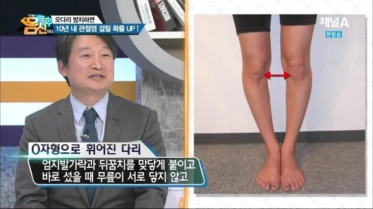 나는 몸신이다 - 오다리 교정