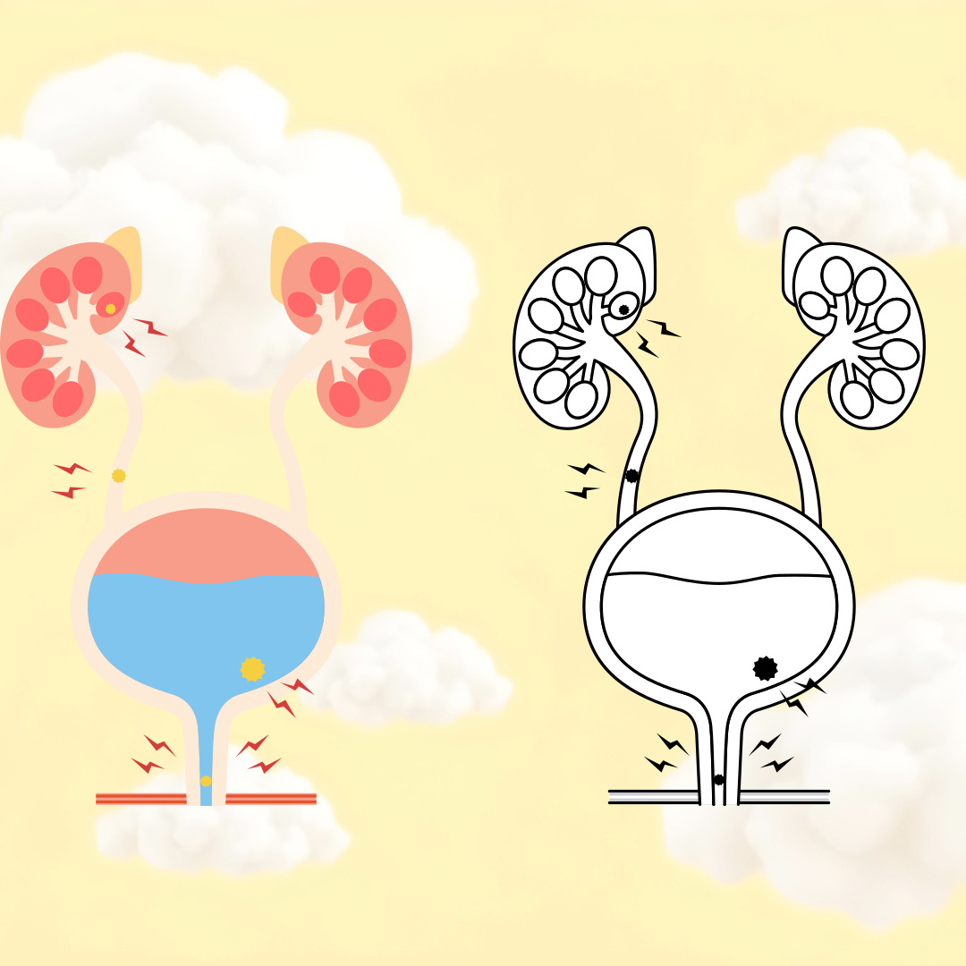 요로결석 관련 그림