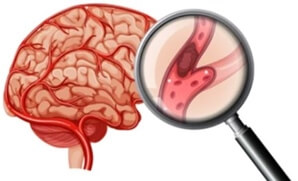 뇌졸중-원인-혈전-사진