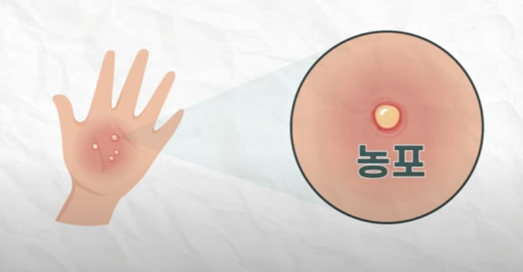  손발바닥농포증에 확실한 관리방법