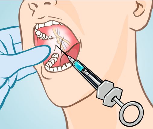 치과 마취주사 부작용, 신경손상 증세, 구강내과 치과의사가 다 알려드림