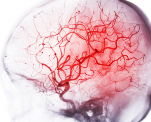 Beware Not Only of the Cold: Understanding the Risks and Prevention of Heat-Related Strokes.