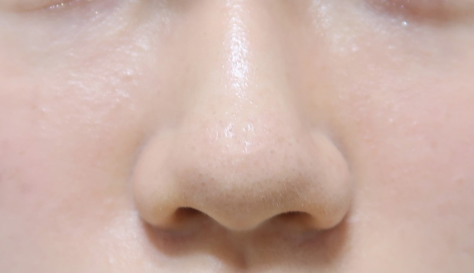 2차 코 봉오리 축소 코 조각 주사 후기교대역피부과 1개월 반 지났어 5