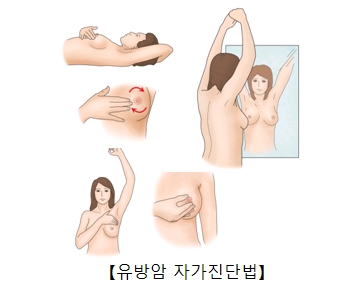 젊은 여성 환자 급증 유방암 5