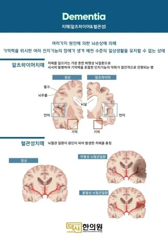 알츠하이머와 치매 차이_26