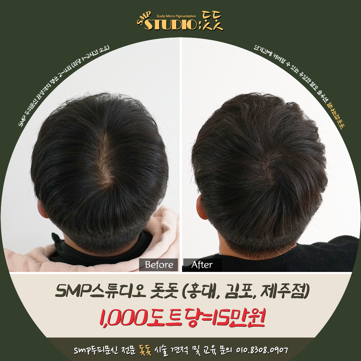  홍대두피문신 단골코스 남자 정수리 탈모 커버