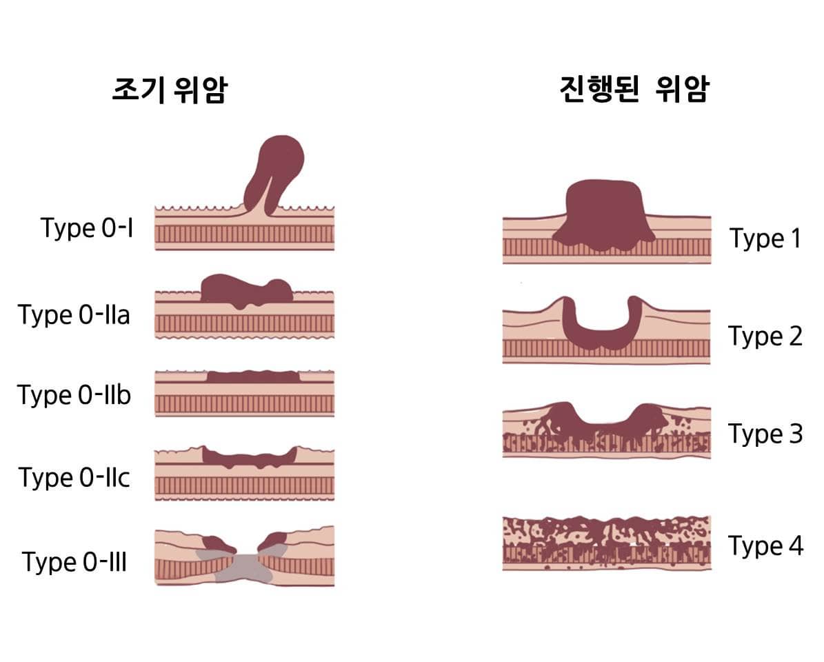 gastric cancer