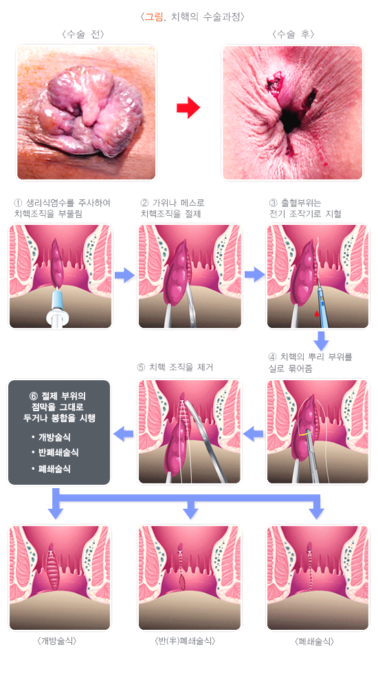 치핵의 수술과정