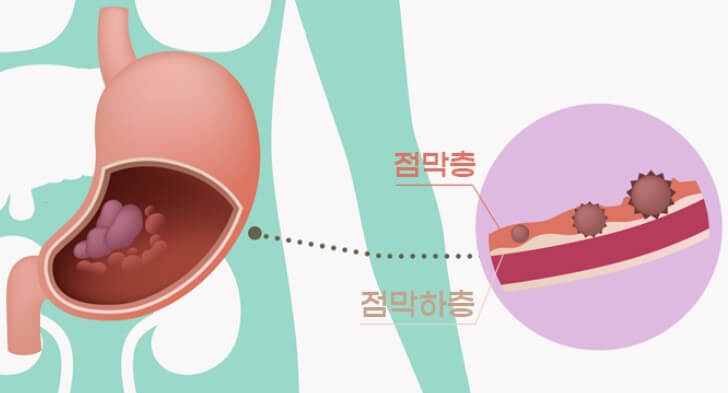  위암 초기증상 5가지 및 단계별 치료방법