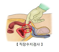 치질 수술
