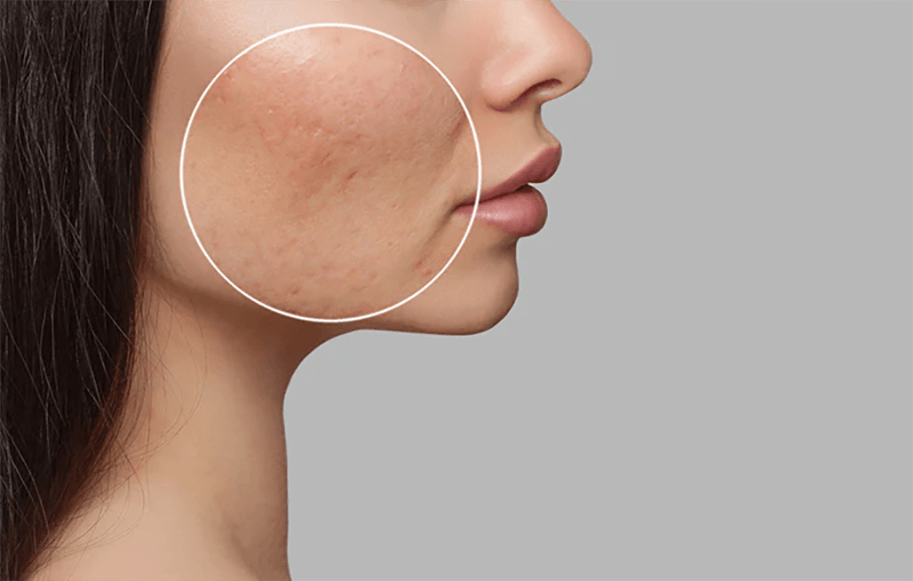 Acne scar management and treatment
