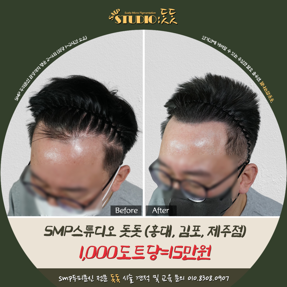 서울 두피문신 견적 확인 방법