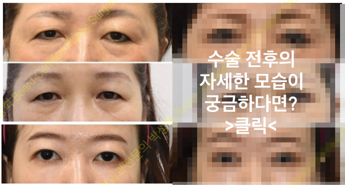 안검하수-눈매교정-차이