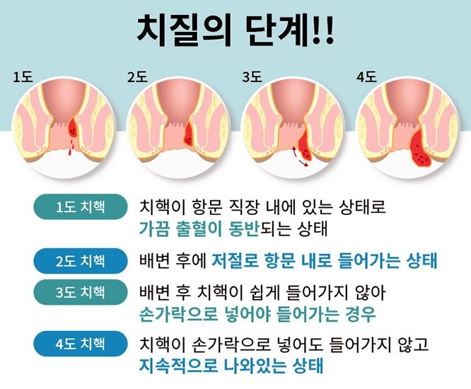  치질 수술과 과정 그리고 통증